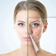 Load image into Gallery viewer, Invisible Acne Removal Pimple Patch