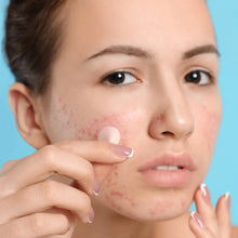 Load image into Gallery viewer, Invisible Acne Removal Pimple Patch