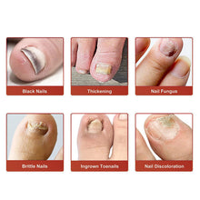 Load image into Gallery viewer, Fungal Nail Patches