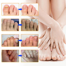 Load image into Gallery viewer, Fungal Nail Patches